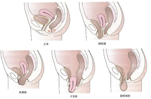 骨盤臓器脱の図
