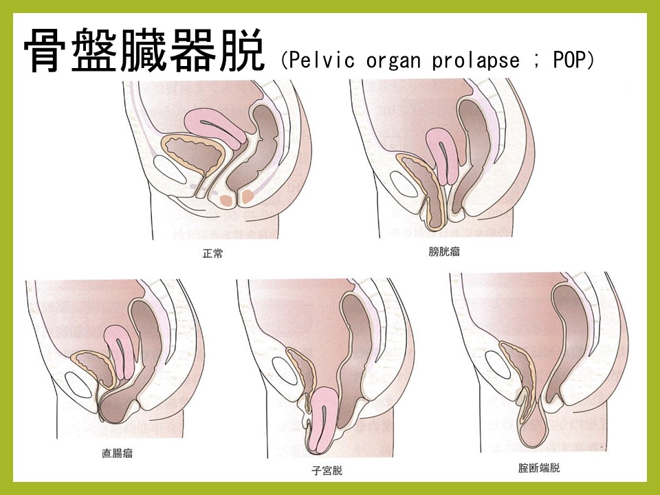 骨盤臓器脱の種類 -女性泌尿器科- 女性医療クリニックLUNA