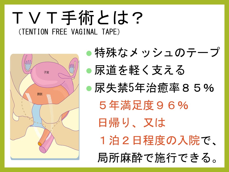 尿失禁手術後の排尿困難と尿失禁手術の歴史 －女性泌尿器科－ 女性医療クリニックLUNA